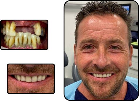 Smile in a day Dental Implants Rochester, Ashford & Barnet.